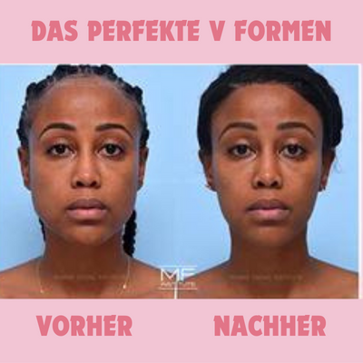 GesichtForm™ Definierende Kieferlinie Optimierung